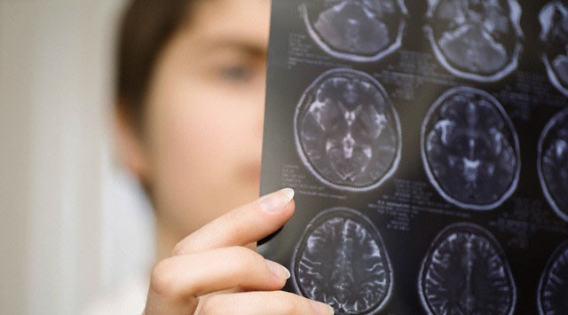 Beyin tümörlerinin erken teşhisi hayat kurtarabilir