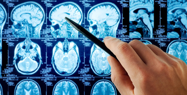 Beyin tümörlerinin erken teşhisi hayat kurtarabilir