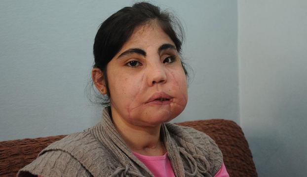 Türkiyede yüz nakli yapılan ilk kadın hayatını kaybetti