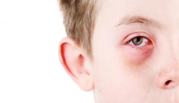 Alerjik bünyeleri olan çocuklar için koronavirüs önlemleri
